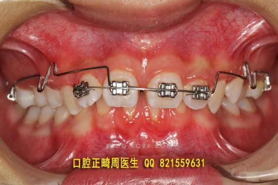 正畸上前牙压低辅弓-图2