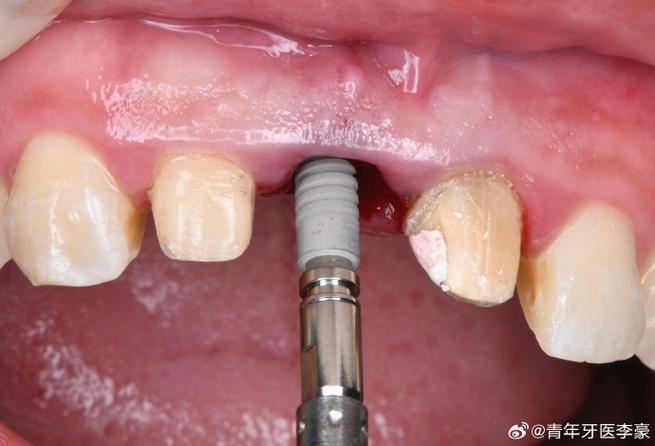 天津即刻种牙-图2