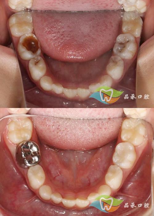 正畸螺钉植入术前，患者需做好哪些关键准备与注意事项？-图2