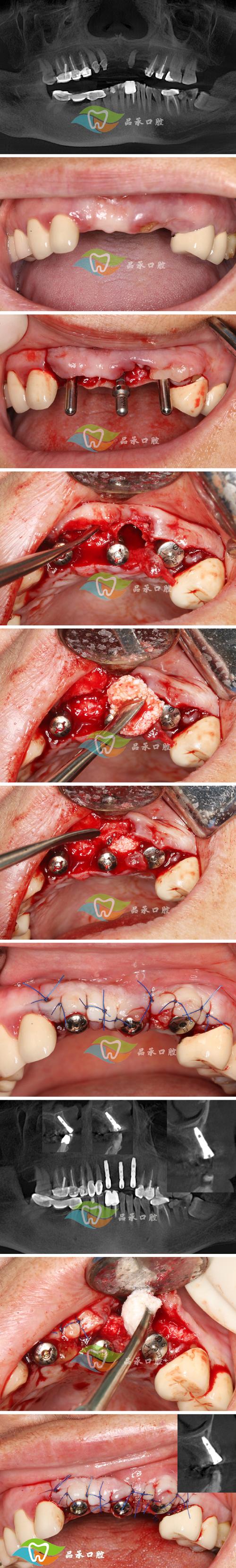 正畸螺钉植入术前，患者需做好哪些关键准备与注意事项？-图1