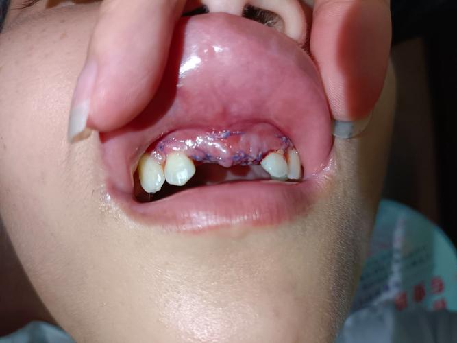 种牙骨粉溢出-图1