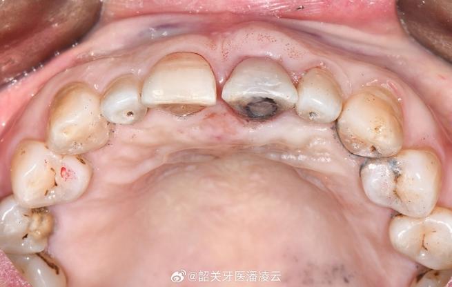 种牙骨粉溢出-图3