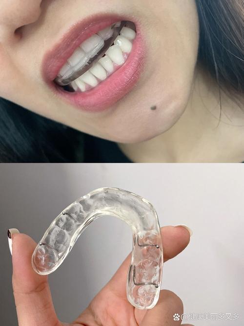 正畸牙弄的白色垫高-图3