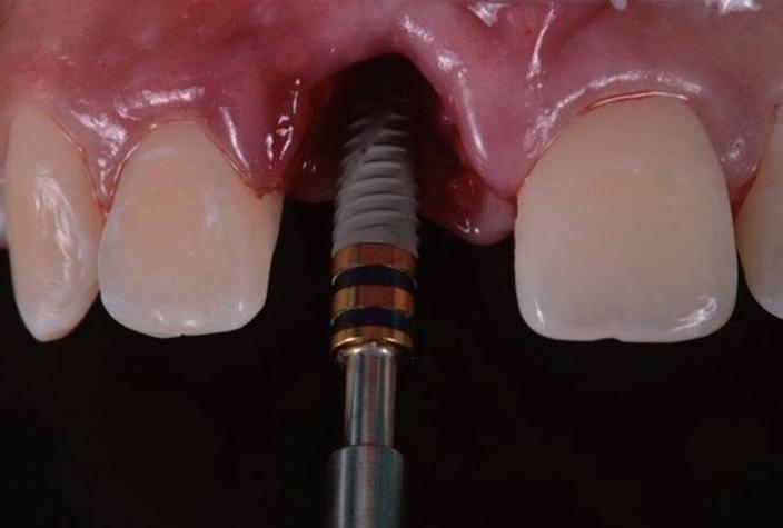 苏州即刻种牙效果如何？当天就能用吗？-图1