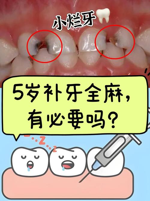 儿童种牙有必要吗？家长必知的适应症、时机及重要性-图1
