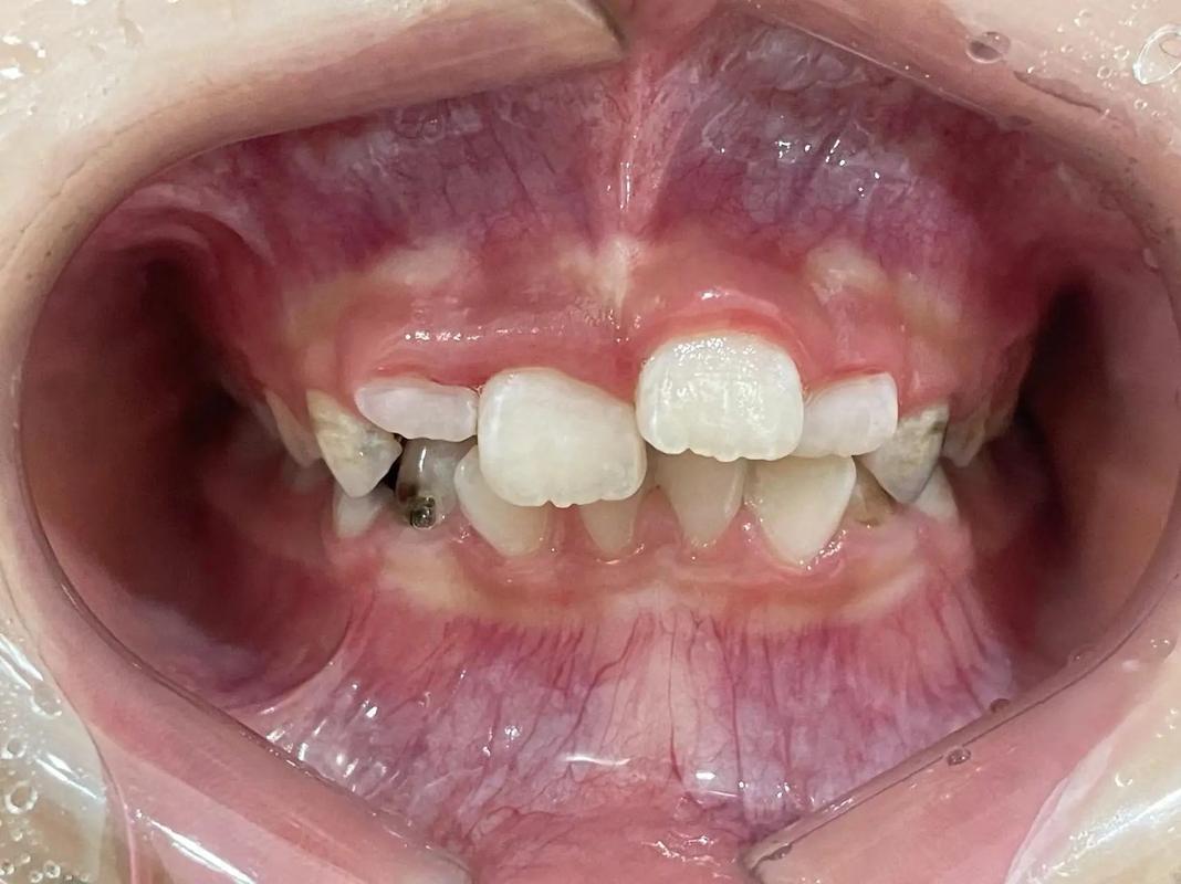 牙齿单侧正畸补缺齿-图3 牙齿单侧正畸补缺齿-图3