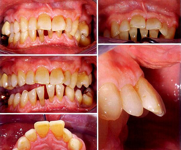 正畸牙周维护是什么-图1