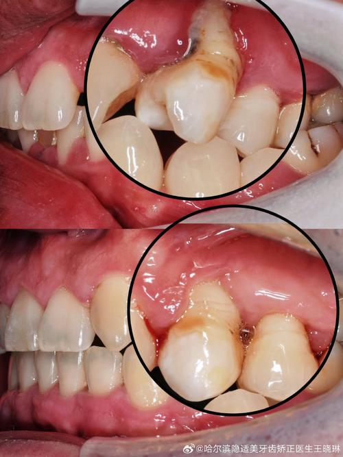 正畸牙周维护是什么-图3