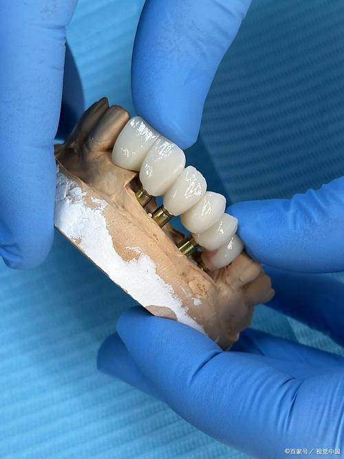 bego种牙技术怎么样？效果与安全性如何？-图2