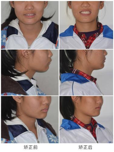 牙齿正畸与脸廓变形-图2 牙齿正畸与脸廓变形-图2