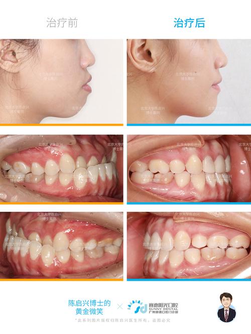 牙齿正畸与脸廓变形-图1 牙齿正畸与脸廓变形-图1