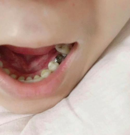 种牙过渡牙小-图2