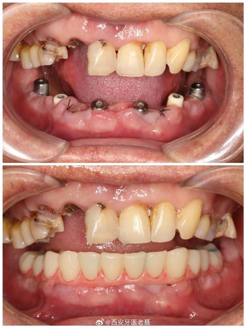 全口牙 种牙-图3 全口牙 种牙-图3