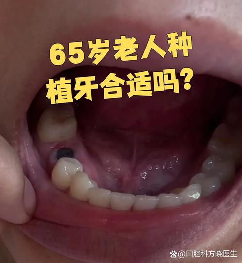 种牙后为何仍缺牙？原因解析与应对指南-图2