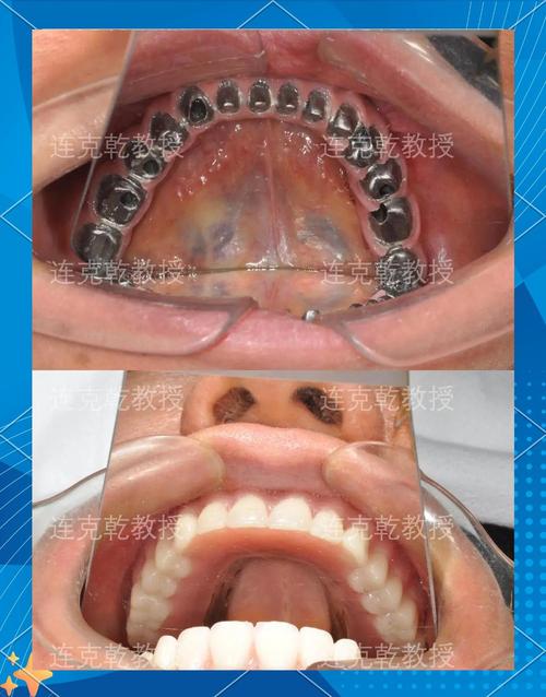 种牙后为何仍缺牙？原因解析与应对指南-图3