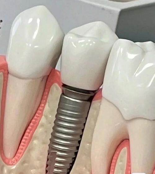 种牙为何用自己牙？自体牙移植的优势何在？-图3