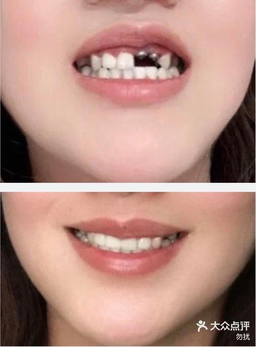 种牙为何用自己牙？自体牙移植的优势何在？-图2