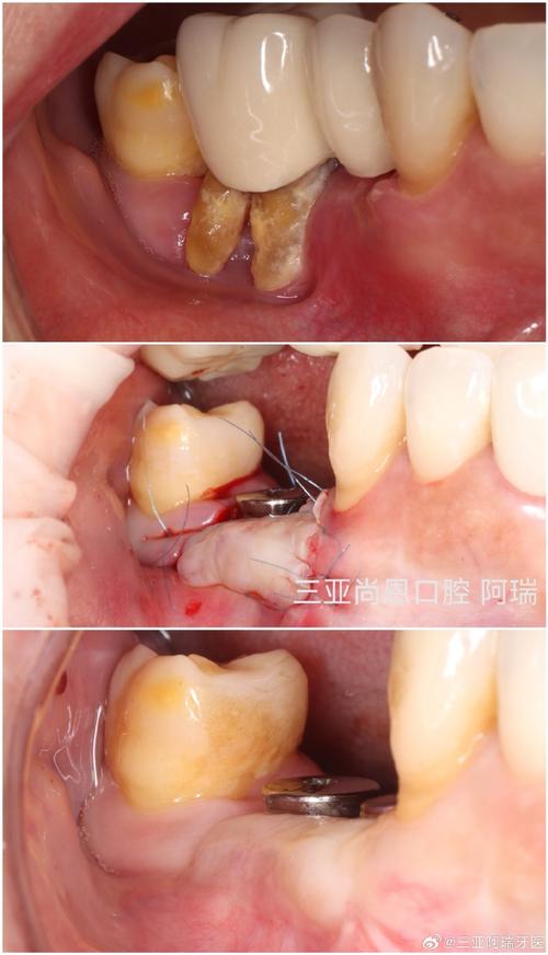 种牙后过渡牙-图2 种牙后过渡牙-图2