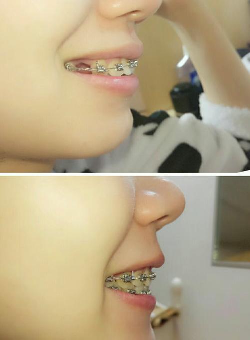 只拔出上合牙齿正畸-图1