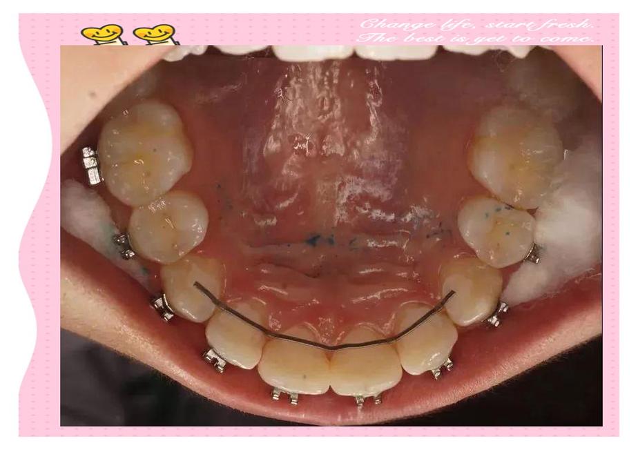 舌侧内固定成人正畸-图3