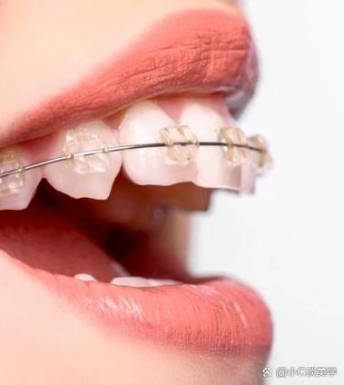 正畸托槽颊面管图片-图3