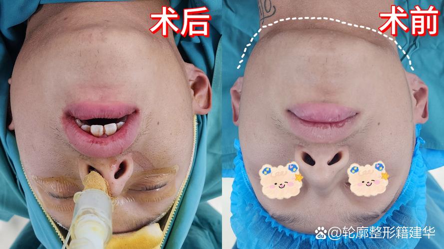 无术前正畸正颌手术-图2