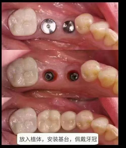 长沙种牙到底好不好？效果、价格和医院选择靠谱吗？-图2