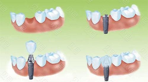 一段式 种牙-图2
