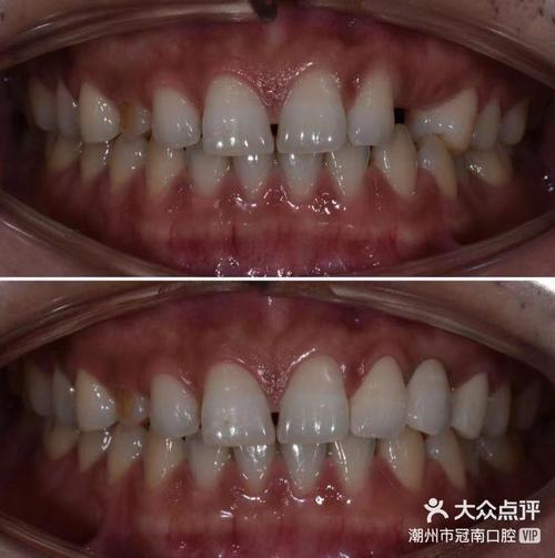 固定桥 种牙-图3