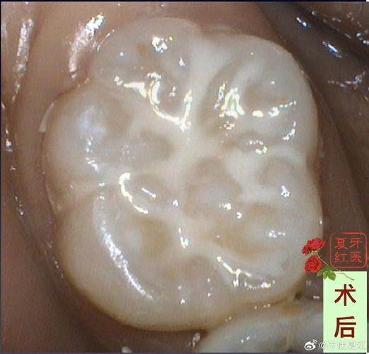 口腔正畸前窝沟封闭-图3
