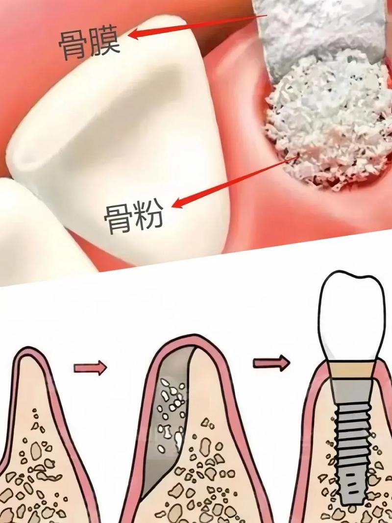 骨粉植入后，多久可以种牙？-图2
