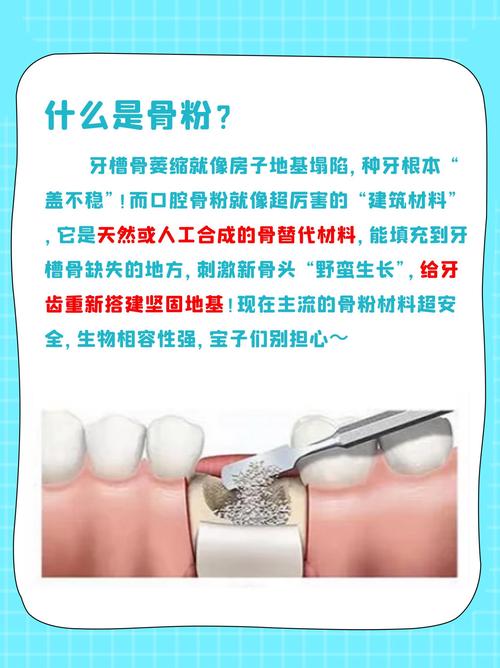 骨粉植入后，多久可以种牙？-图3