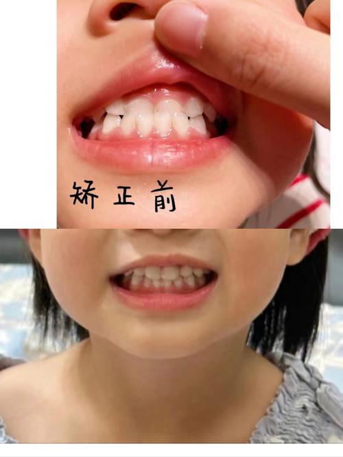 儿童牙齿地包天正畸，何时开始矫正最合适？-图2