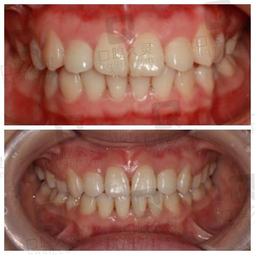 华美正畸效果怎么样-图1