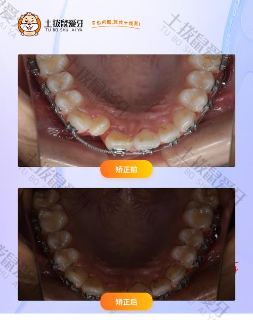 上海门牙正畸哪家医院靠谱？-图3