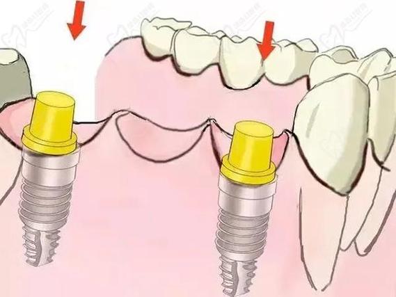 种牙愈合基台-图2