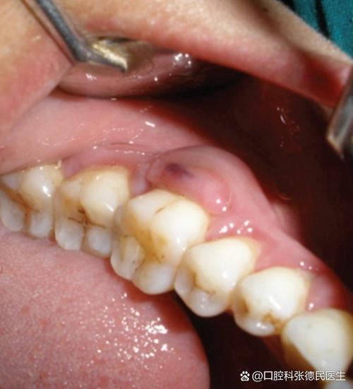 种牙 牙龈肿-图1 种牙 牙龈肿-图1