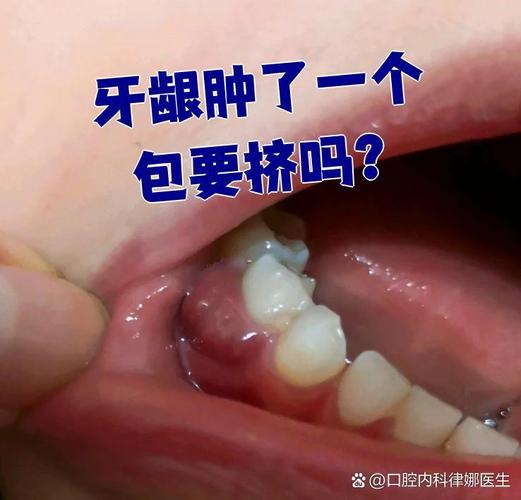 种牙 牙龈肿-图3 种牙 牙龈肿-图3