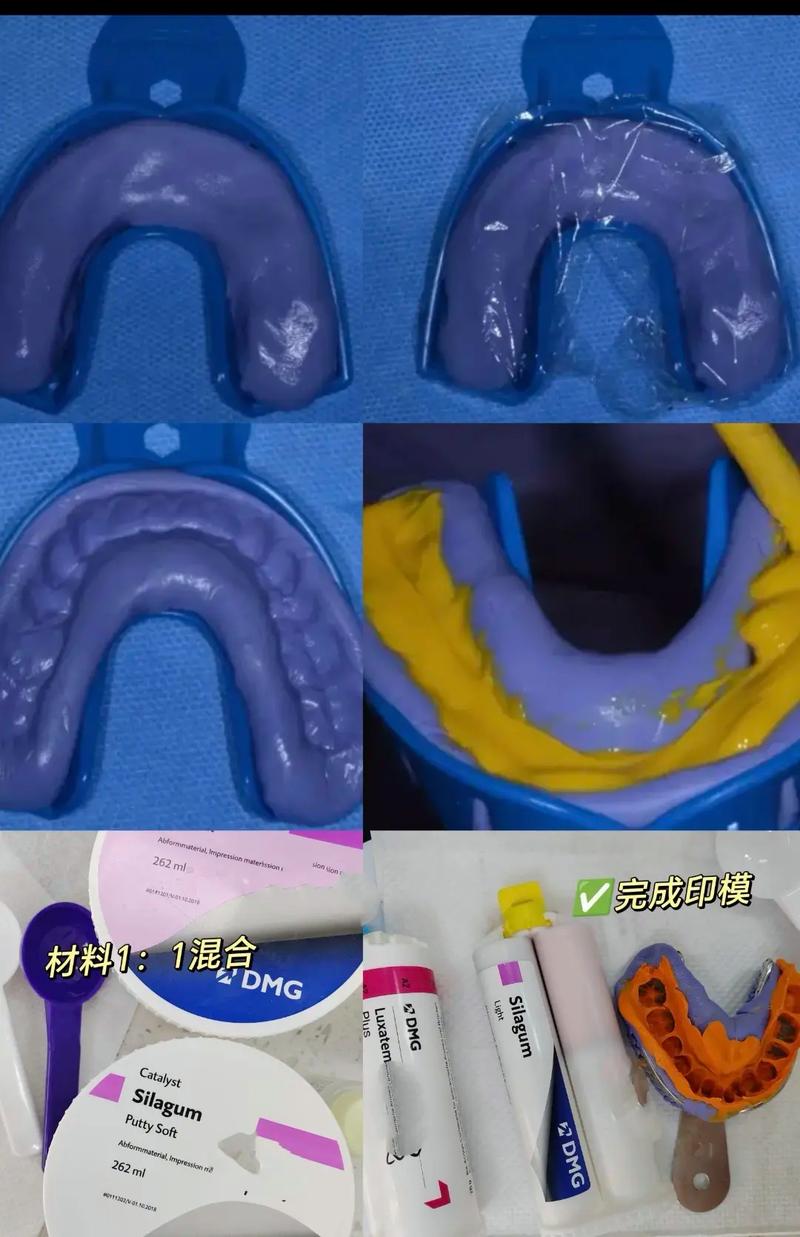 正畸硅橡胶取模方法-图1