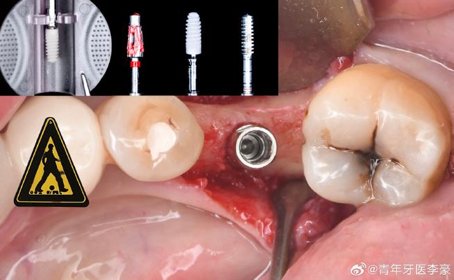 种牙移植牙龈-图2