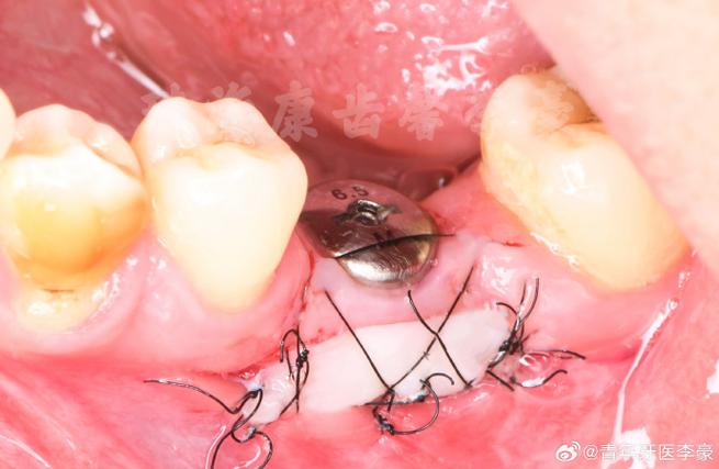 种牙移植牙龈-图1