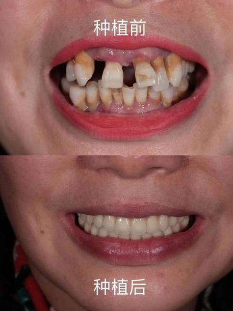 种牙越种越差-图1