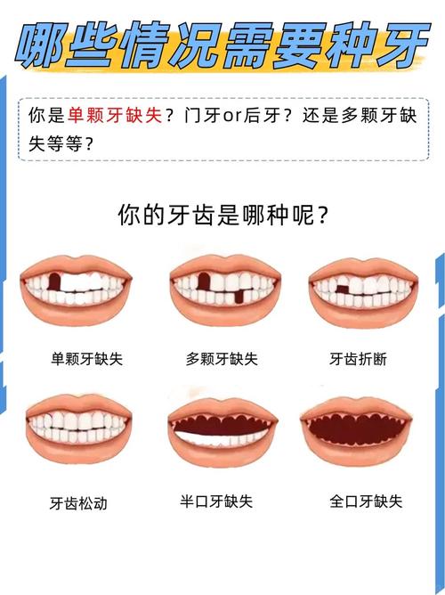 种牙越种越差-图2