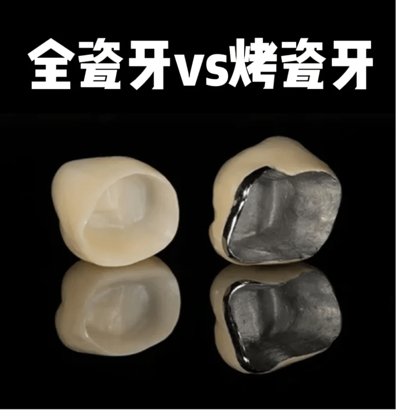 全瓷牙与种牙有何区别？缺牙修复该如何正确选择？-图2