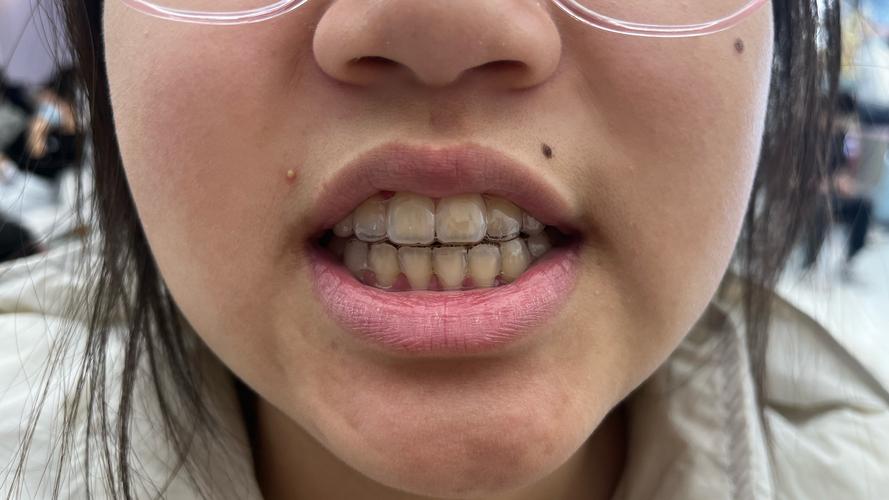 北大口腔正畸后失败-图1 北大口腔正畸后失败-图1