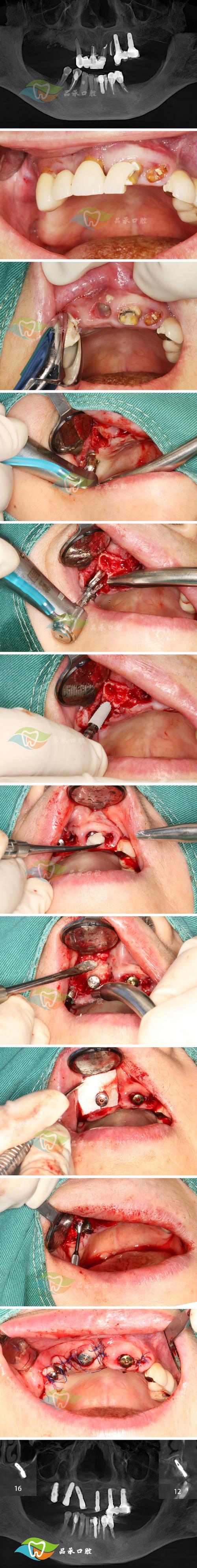 种牙三期手术-图3