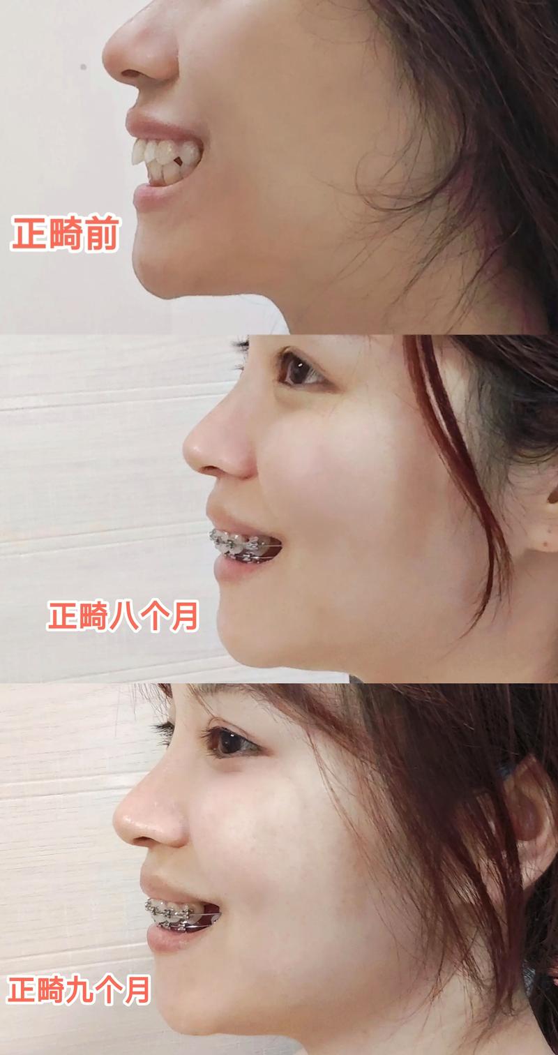 正畸是最漫长的整容-图1
