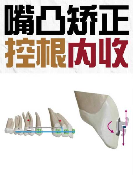 正畸前牙控根的方法-图2