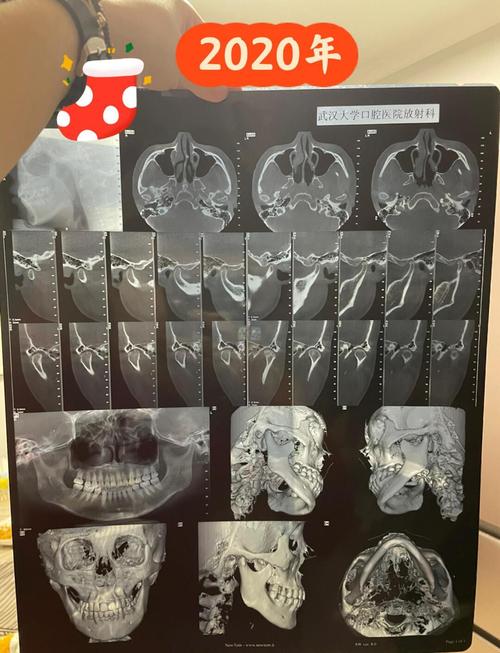 髁突吸收怎么做正畸-图1