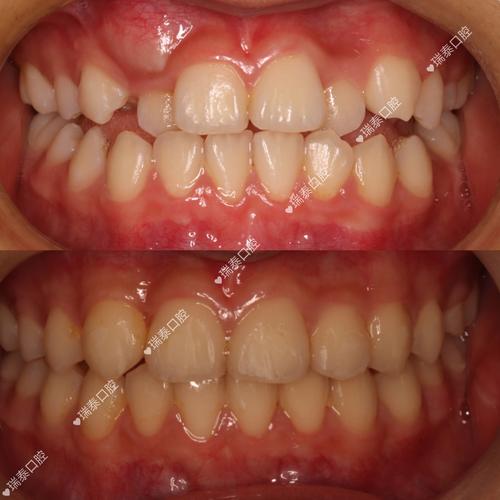 正畸下牙列整体前移，效果如何？风险可控吗？-图2
